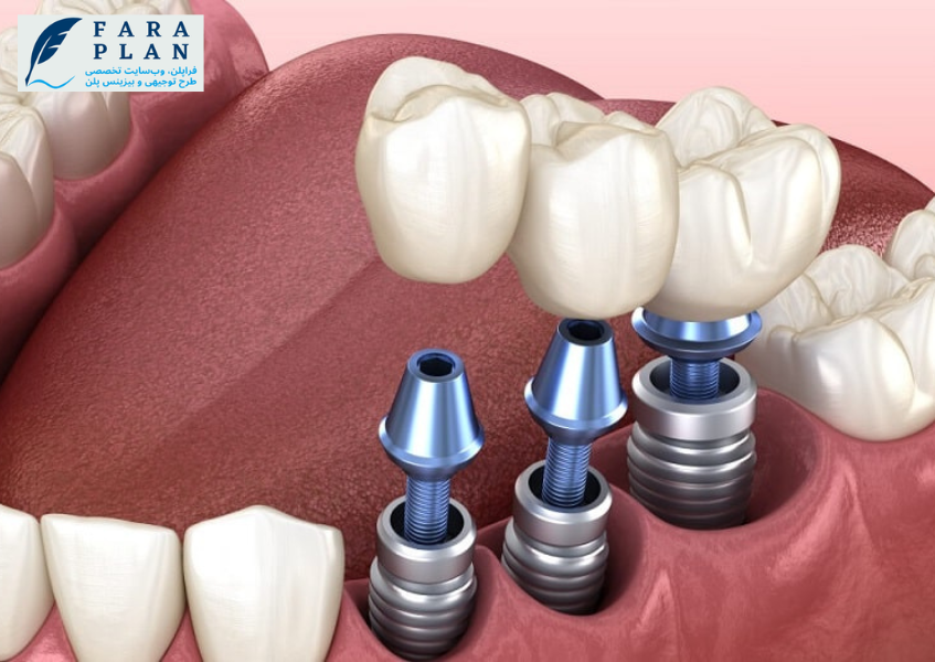 ایمپلنت دندان