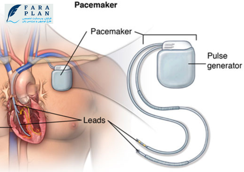 نحوه کارکرد سیستم محرک ماهیچه قلب یا پیس میکر
